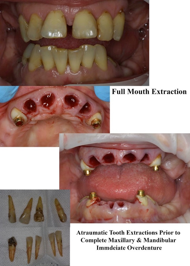 Oral Surgery Wisdom Teeth Removal 89